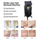 The Most Popular Diode Laser 808 755 1064nm Diode Laser Hair Removal Machine Wholesale Price