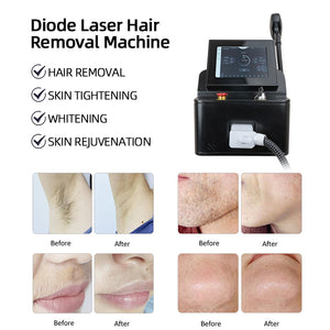 808 Hair Removal Nd Yag Laser Hair Removal Machine